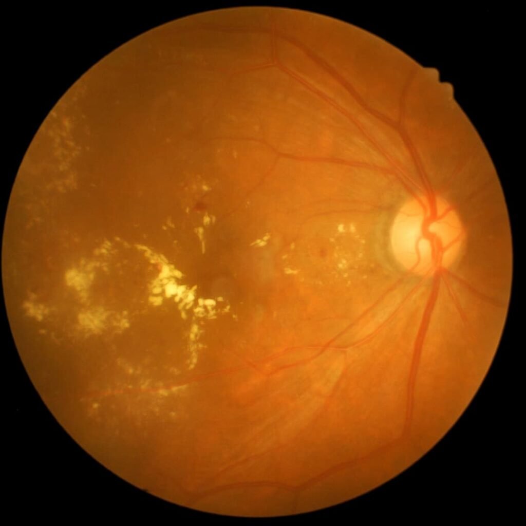 Diabetic Retinopathy - Causes, Signs, And Treatment. - Chadderton Opticians