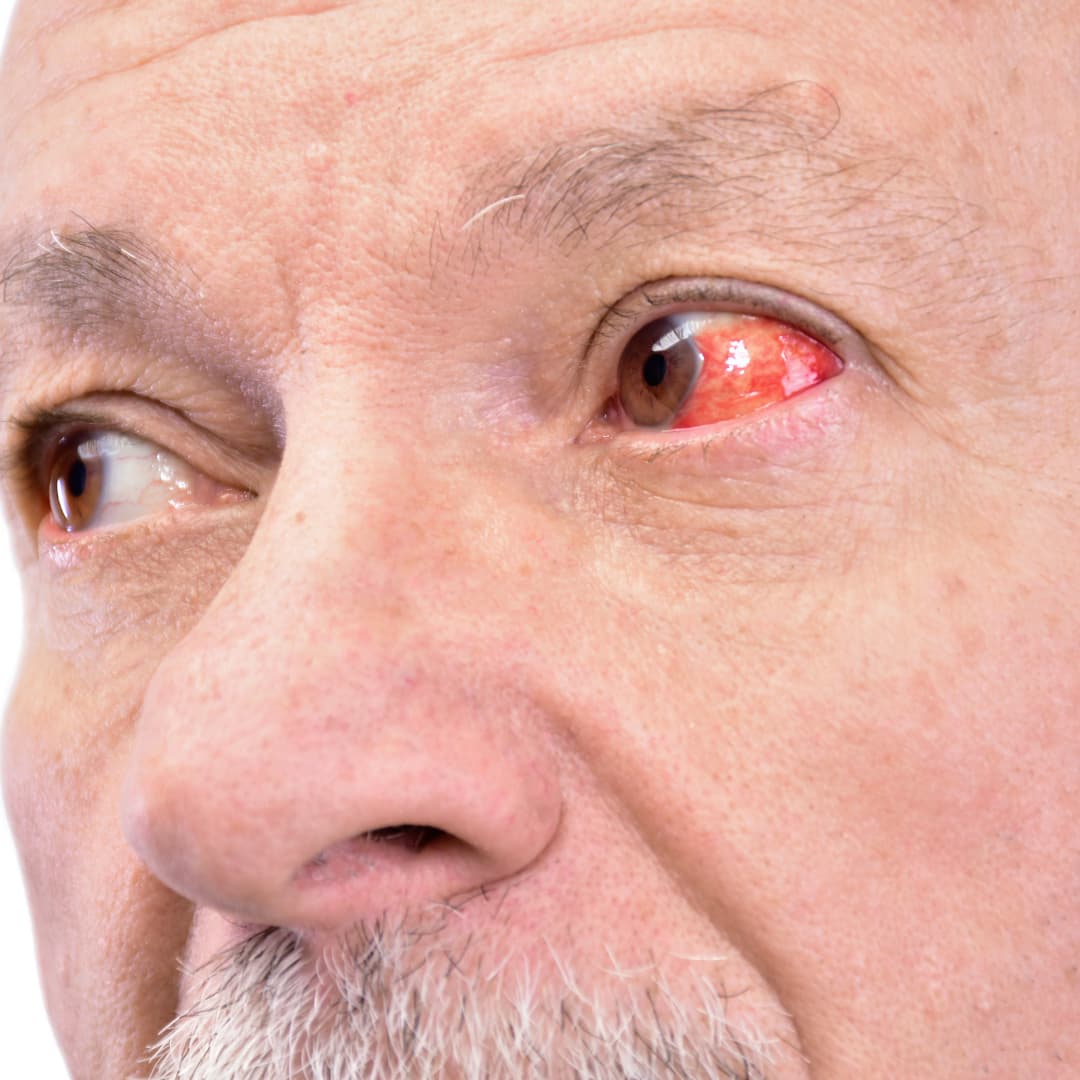 red-eye-symptoms-and-treatment