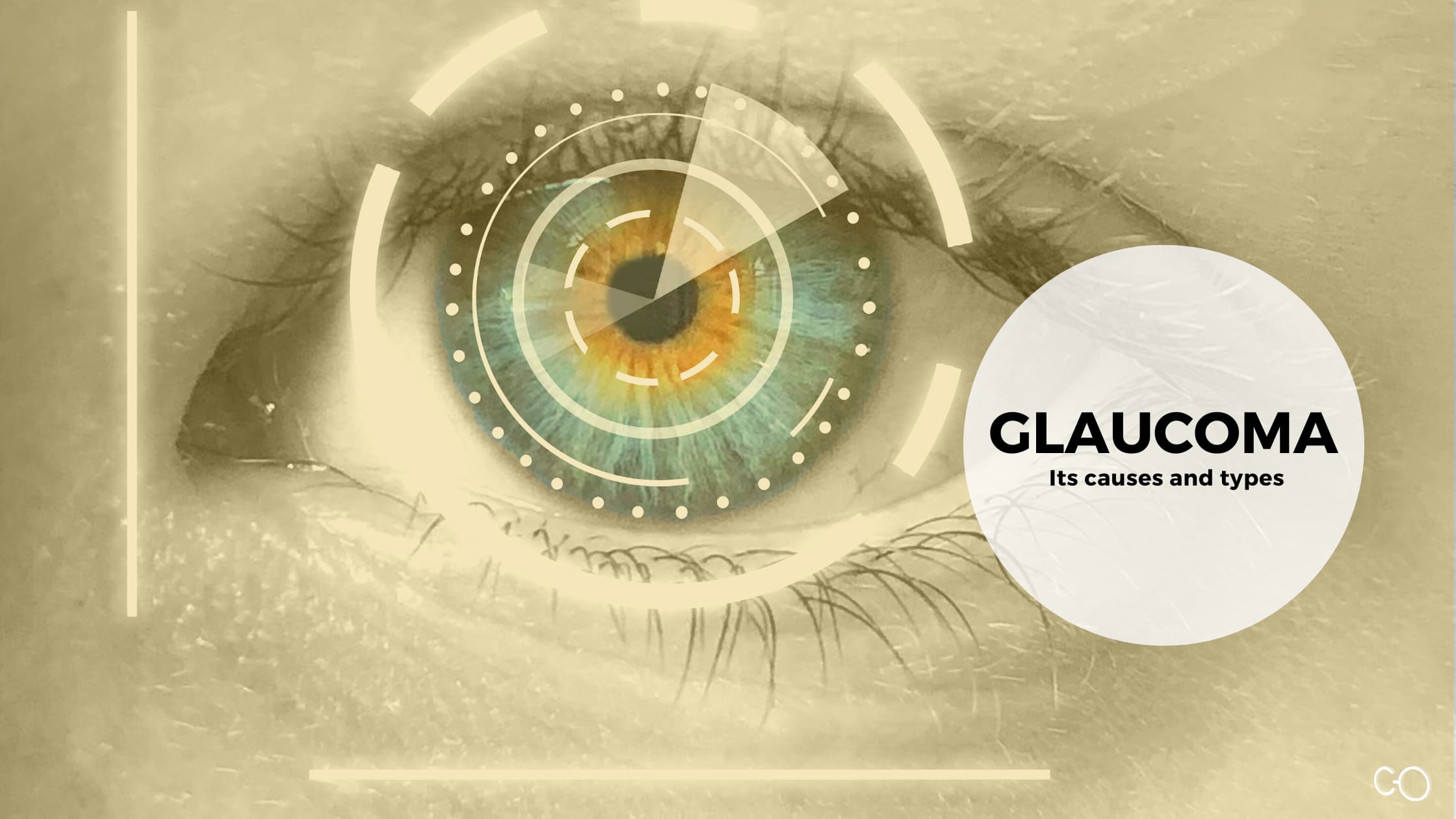The causes and types of glaucoma