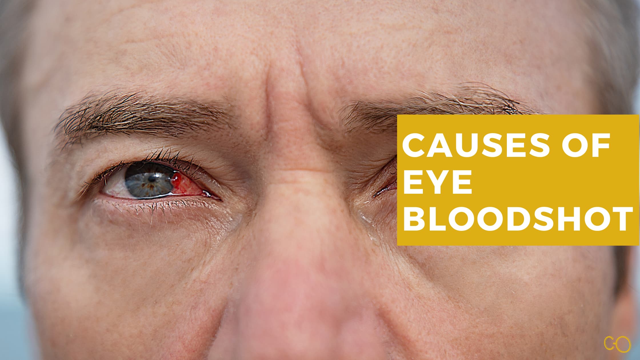 What casues eye bloodshot